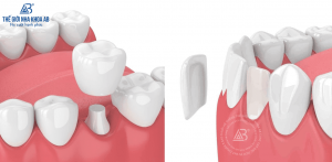 boc-rang-su-dan-veneer