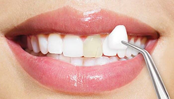 Dan Rang Su Veneer 4