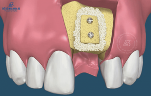 ghep-xuong-trong-cay-ghep-implant2