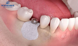 ghep-xuong-trong-cay-ghep-implant3