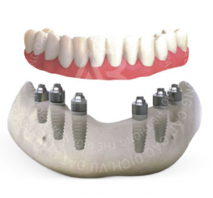 phuc-hinh-implant-all-on-6