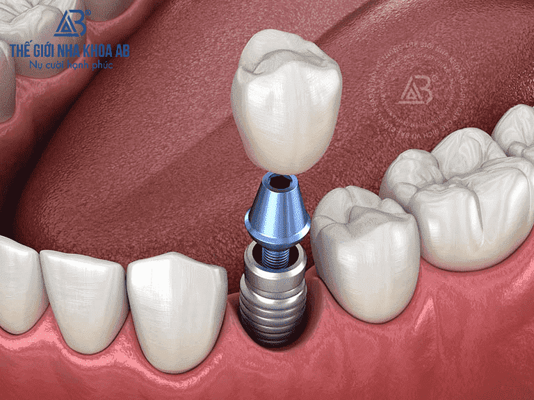 phuc-hinh-su-implant