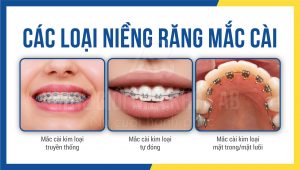 Các loại niềng răng mắc cài