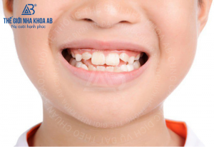 Cac Van De Rang Moc Lech O Tre 6 10 Tuoi 1