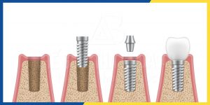 Cay Ghep Implant Tu A Z