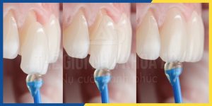 Dan Rang Su Veneer Sieu Mong Sieu Ben Sieu Chan Thuc