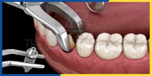 Dat Implant Tuc Thoi Sau Khi Nho Rang