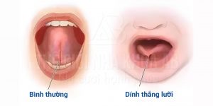 Dinh Thang Moi Va Luoi Cach Nhan Biet Va Dieu Tri 1