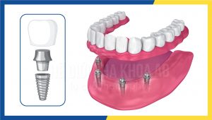 Khoe Hon Dep Hon Nho Trong Rang Implant Toan Ham