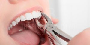 Nho Rang Khong Dau Dam Bao An Toan Tuyet Doi