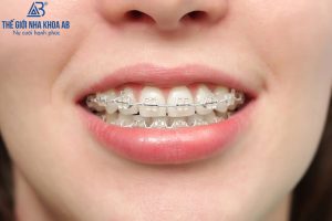 Qua Trinh Nieng Rang 3