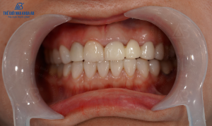 Quy Trinh Che Tac Rang Su Hien Dai Tai The Gioi Nha Khoa Ab 3