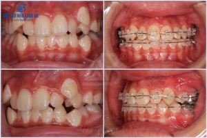 Rang Loi Xi La Gi Cach De Tranh Bi Loi Xi Cho Tre 3