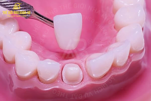 Rang Tre Bi Thua Co Chinh Duoc Khong 1