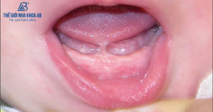 Rang Tre Bi Thua Co Chinh Duoc Khong 3