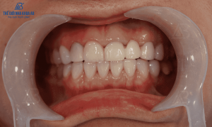 quy-trinh-che-tac-rang-su-buoc4