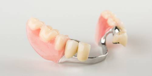 Clasp Prosthesis With Lock Fixation