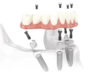 Ham Thao Lap Tren Tru Implant