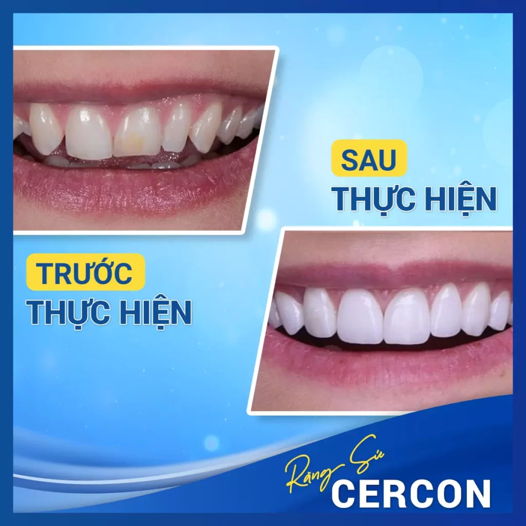 Before After Rang Su Cercon 1