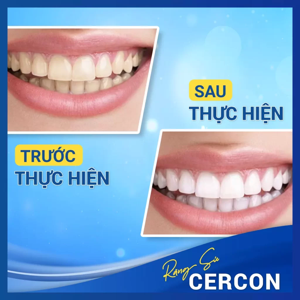 Before After Rang Su Cercon 2