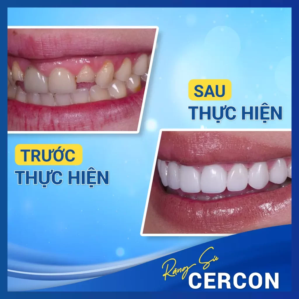 Before After Rang Su Cercon 4