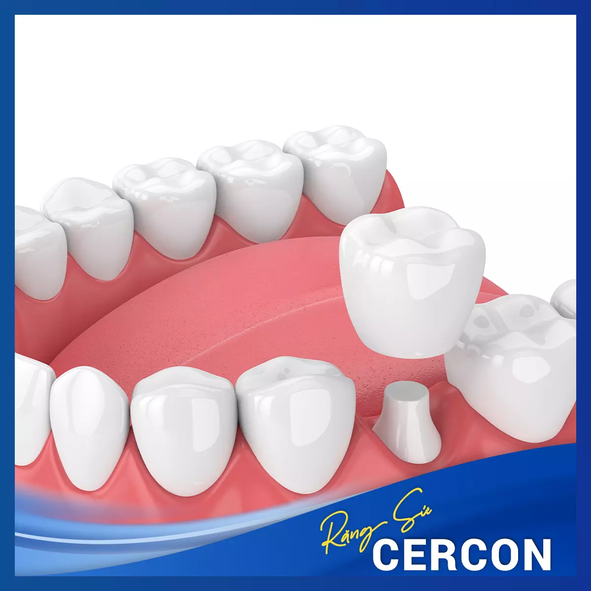 rang-su-cercon-la-gi