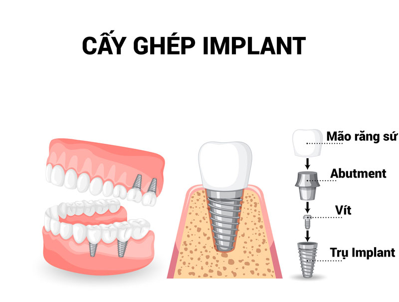 Cay Ghep Implant