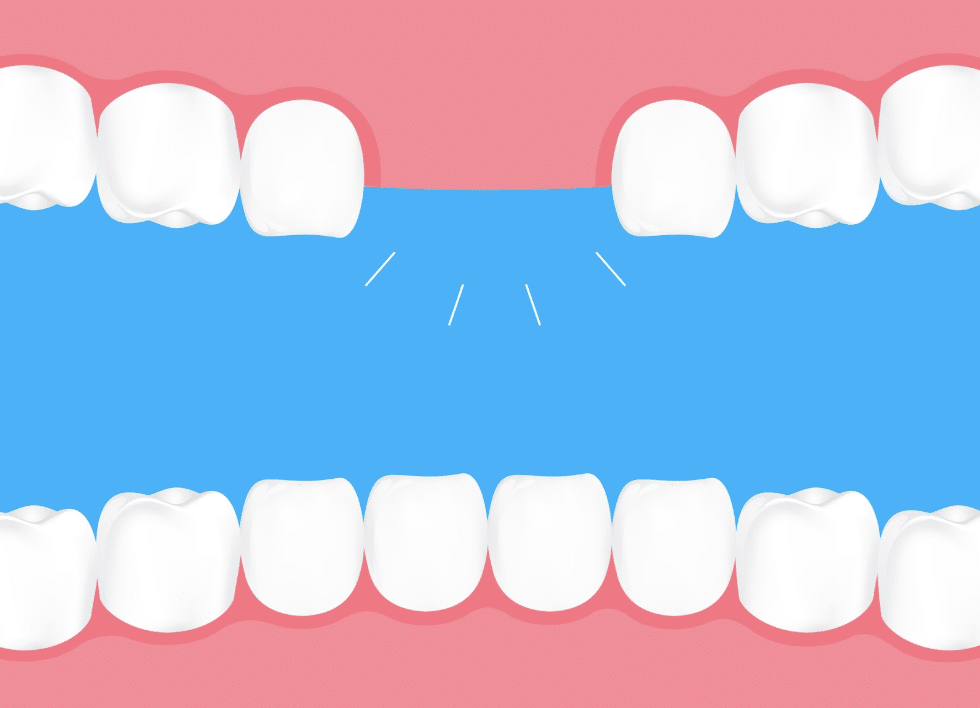 Cay Ghep Rang Implant