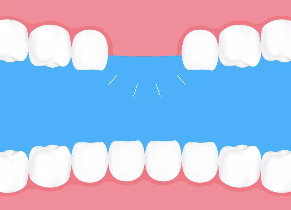 Cay Ghep Rang Implant