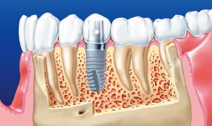Chi Phi Cay Ghep Implant