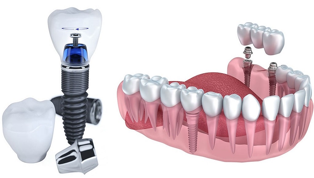 Nhuoc Diem Cua Trong Rang Implant