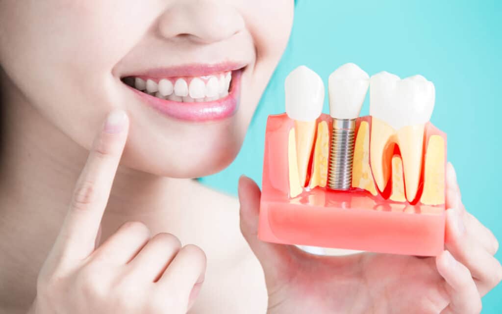 Trong Rang Implant Co Nguy Hiem Khong