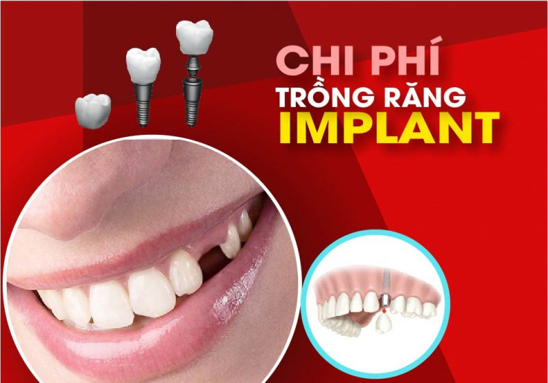 Trong Rang Implant Gia Bao Nhieu