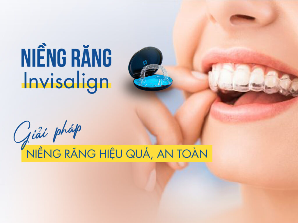 Nieng Rang Invisalign La Gi (2)