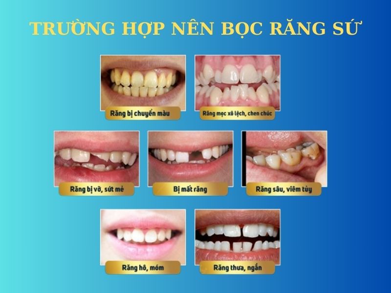 Boc Rang Su Cho Nhung Truong Hop Nao