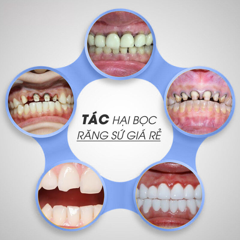 Boc Rang Su Gia Re Co Tot Khong