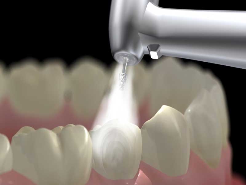 Cao Voi Rang Bang May Sieu Am