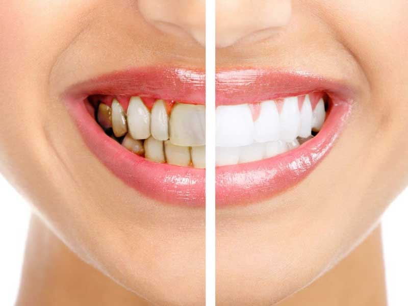 Su Khac Nhau Giua Cao Voi Rang Va Tay Trang Rang