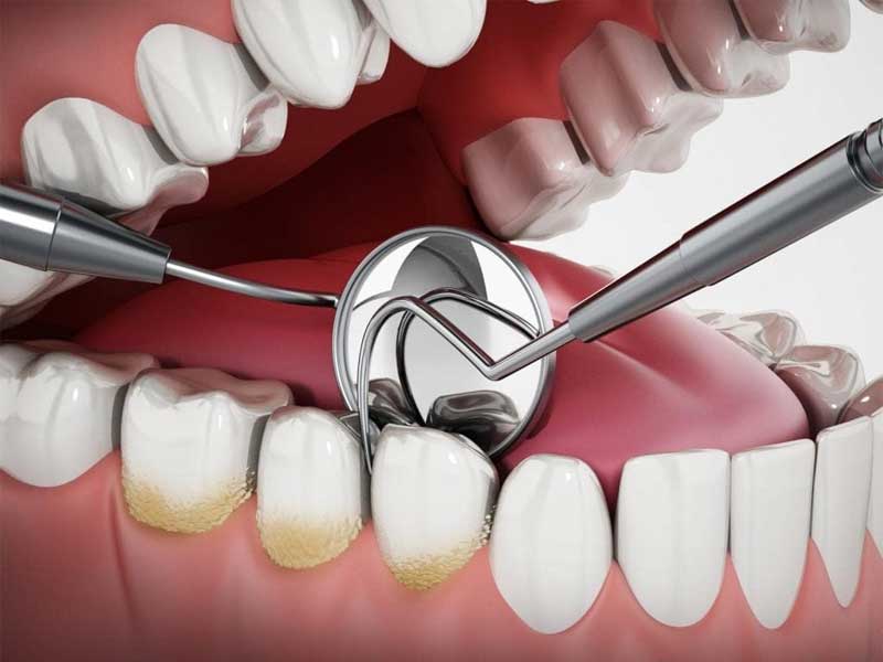 Tim Hieu Nguyen Nhan Hinh Thanh Cao Rang