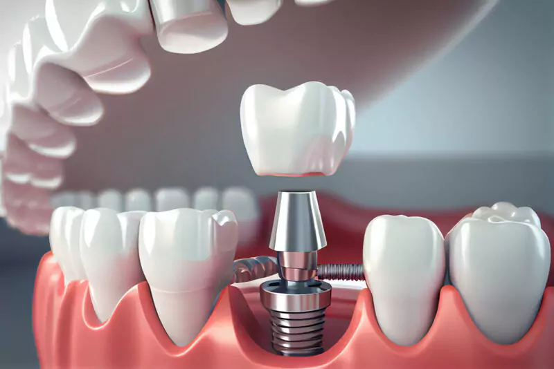 Trồng răng Implant