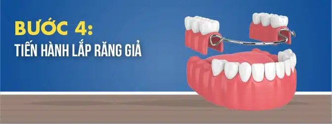 Quy Trình Làm Răng Giả Tháo Lắp 4