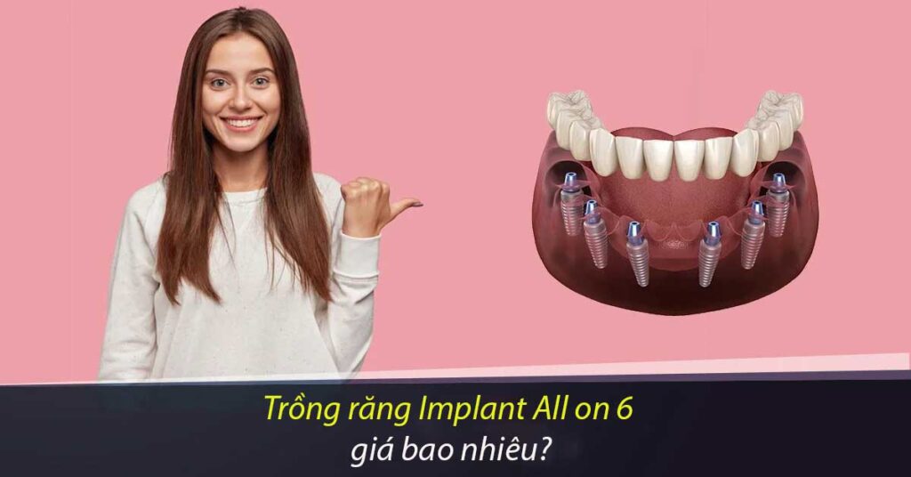 Trong-rang-implant-all-on-6-gia-bao-nhieu