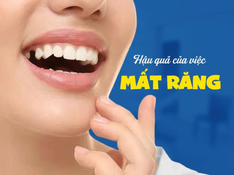 Hậu quả của việc mất răng nghiêm trọng như thế nào?