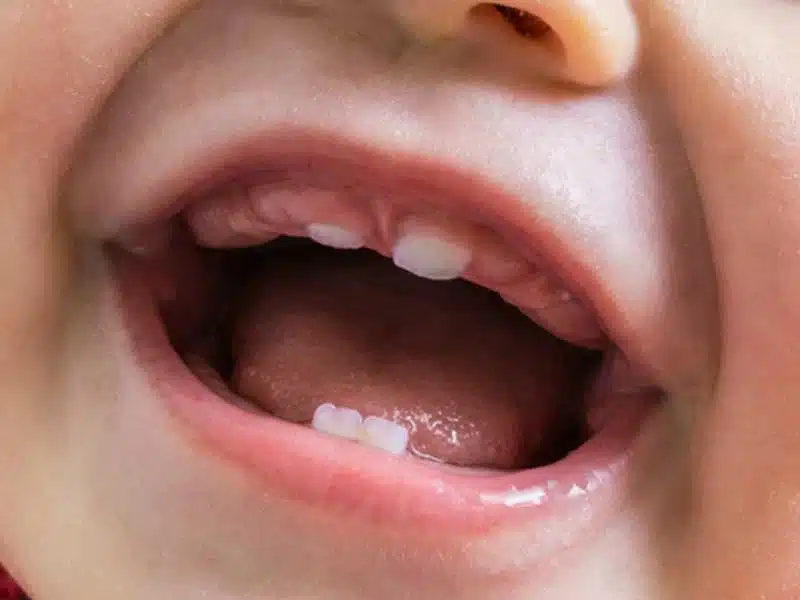 Dấu Hiệu Mọc Răng Ở Trẻ: Nhận Biết Sớm Và Cách Chăm Sóc