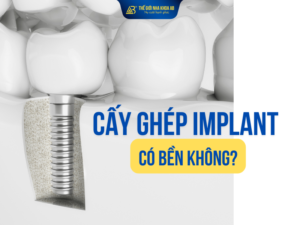Cấy ghép implant có thể bền đến trọn đời