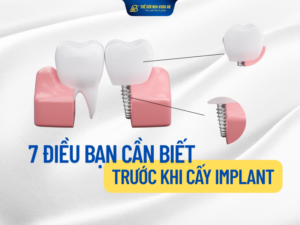 7 điều cần lưu ý trước khi cấy ghép implant