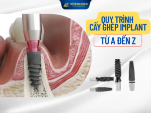 Quy trình cấy ghép implant từ A đến Z