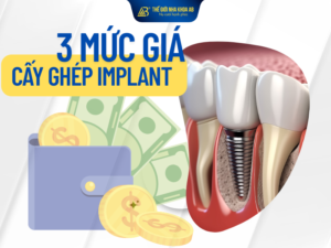 Giá Cấy Ghép Implant đa dạng