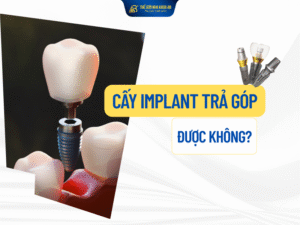 Cấy Implant trả góp giúp việc trồng răng dễ dàng