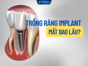 Trồng Răng Implant Mất Bao Lâu